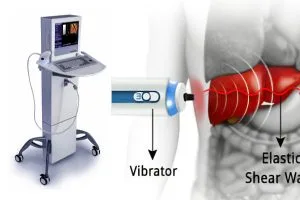 FibroScan liver assessment equipment