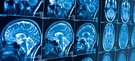 MRI brain scan images
